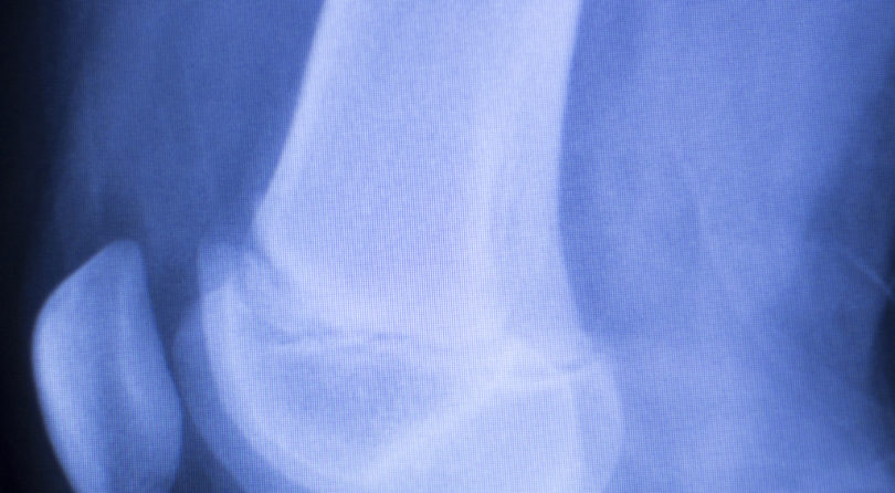 HHS Will Test Bundled Fee for Joint Replacements